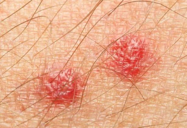 宫颈不好的人,做好2事,少吃2种食物,或能让hpv渐渐转阴