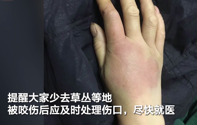 被蜈蚣咬了一口,女子窒息身亡!医生:第一时间应这样做