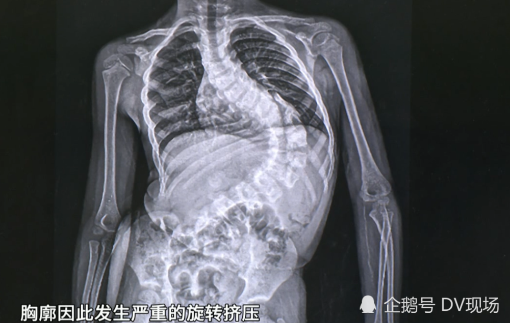5岁男童脊柱侧弯超100度心肺功能受影响