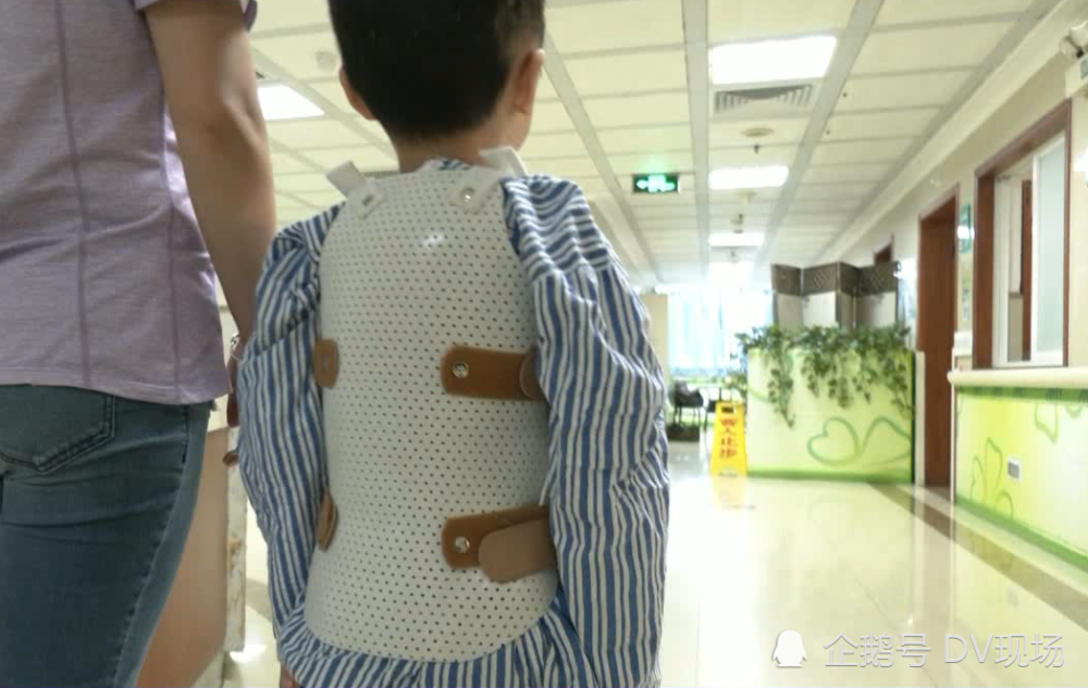 5岁男童脊柱侧弯超100度心肺功能受影响