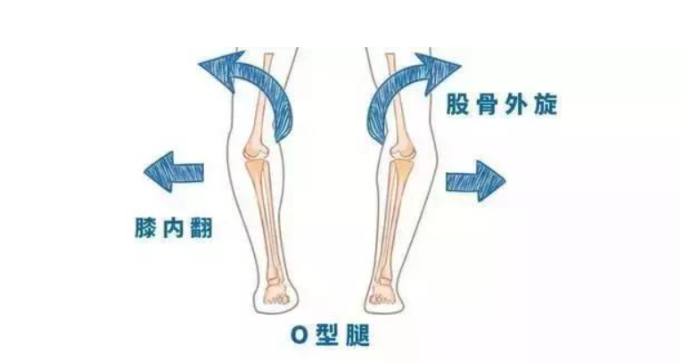 改善动作:(建议每个动作15次,做3组)step1: 拉伸髋外旋肌,平躺,双手