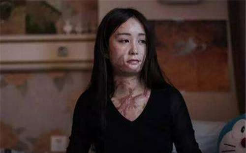 16岁女孩因婉拒官二代追求,被泼硫酸毁容,9年过去,她已大变样