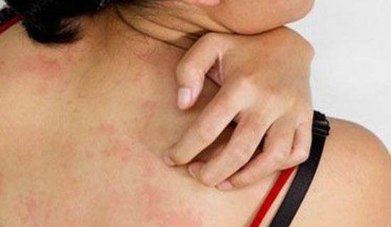 皮肤瘙痒:一般出现皮肤发痒的症状时,会被肝癌患者当做皮肤病去治疗
