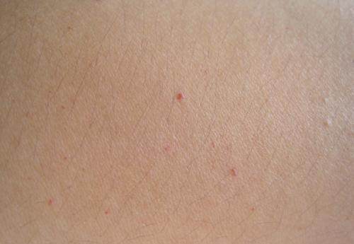 皮肤发出这些信号暗示你肝坏了一发现赶紧治再拖肝癌到晚期