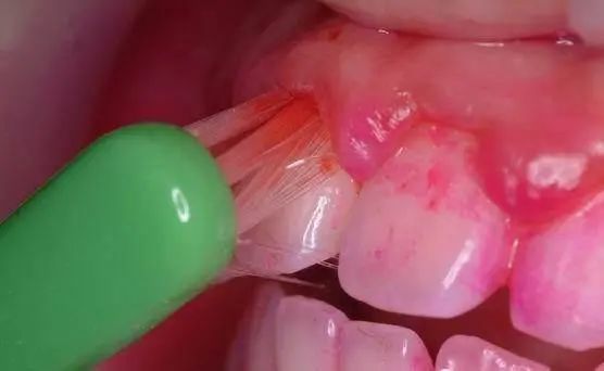 牙龈肿痛牙齿出血是上火大错特错这可能是严重的牙周病