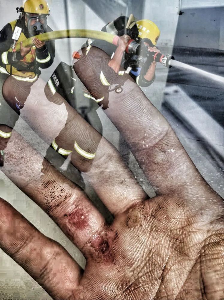 消防战士的受伤的手图片