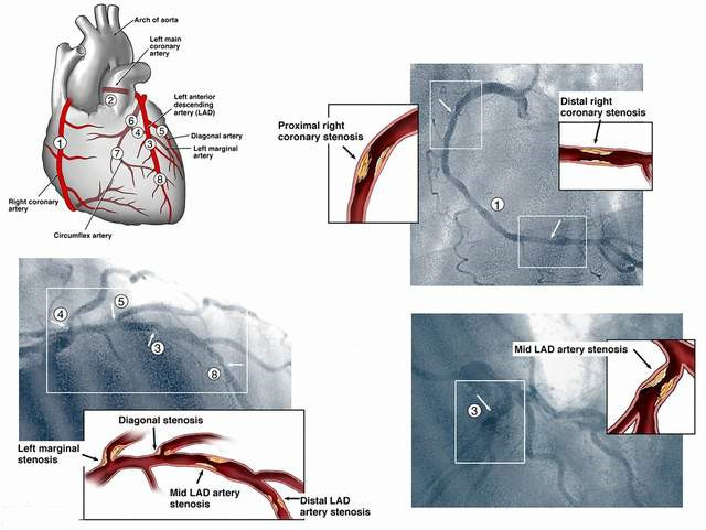心脏造影有哪些危害和风险什么样的人才适合做心脏造影检查
