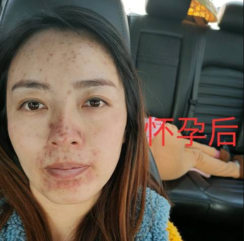 易长妊娠黄褐斑女人在孕期,由于黑色素细胞激素分泌得也要比之前多,这