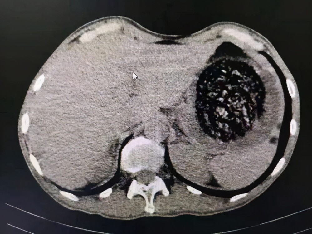 胃石症图片图片