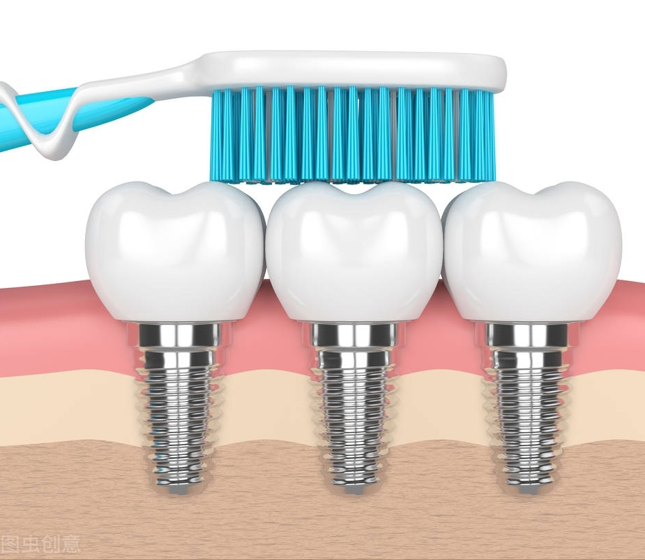 種植牙是目前修復牙齒缺失的常規治療方式之一,臨