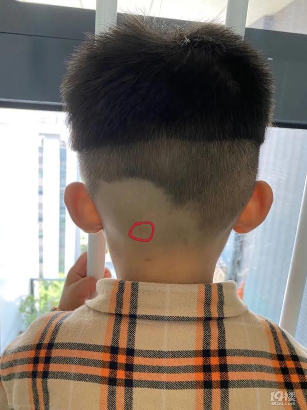 孩子脖子后有颗粒状物医院一查竟是肿瘤