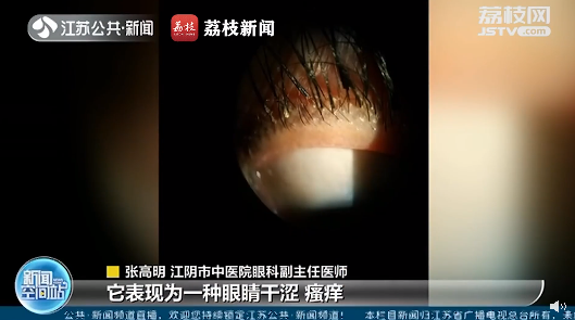 种睫毛竟引发眼部螨虫感染这些症状一定要注意