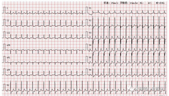 每日读图|第1367期 阵发性室上性心动过速|室上性心动过速|心电图