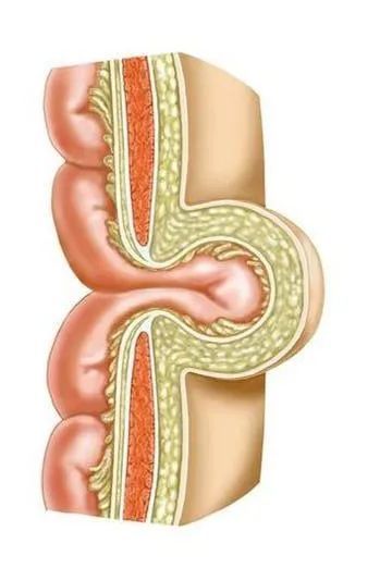 hernia关于"疝气"那点事儿什么是疝?