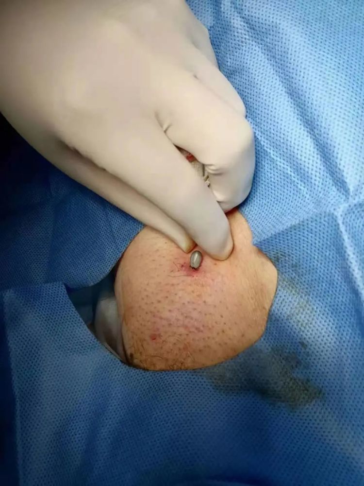 小心!浙江已有人被咬!严重可致命