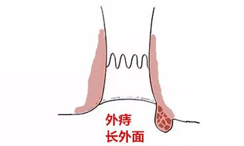 用简单的话说就是生长在肛门外的痔疮,外痔明显的症状有:疼痛,异物感