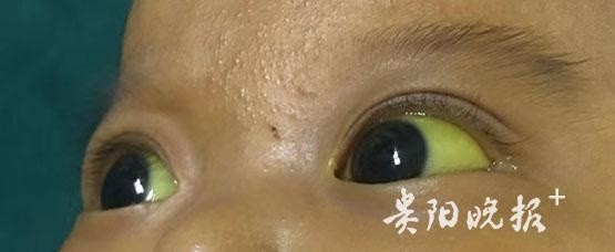 5个多月婴儿成绿巨人遵义宝爸割肝救子同肝共苦