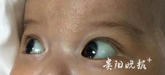 儿童巩膜黄染早期图片图片