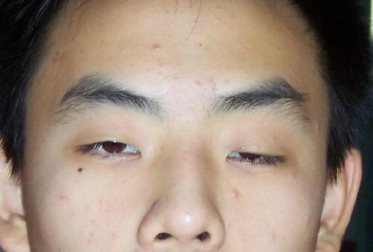 重症肌无力不单是眼无力那么简单知道这些你就该重视它了