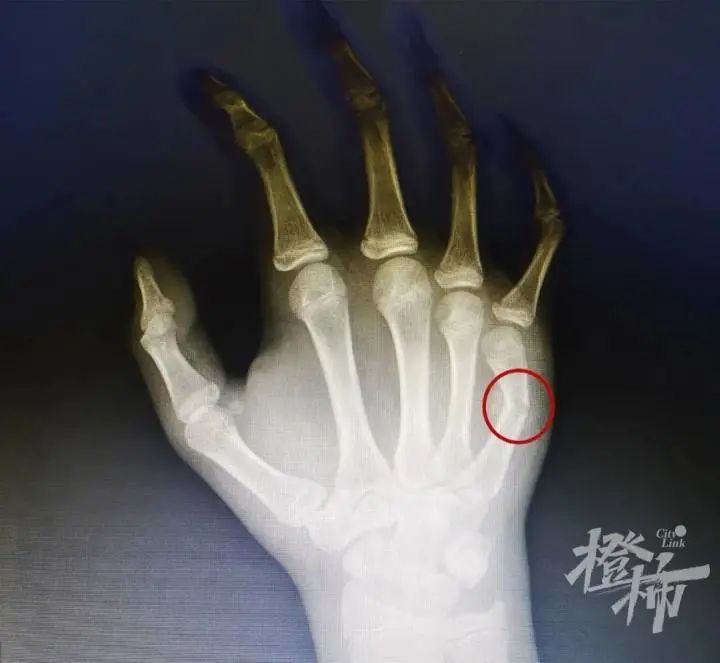 杭州14岁孩子因为玩手机和母亲吵架一拳打穿门板后手指骨折