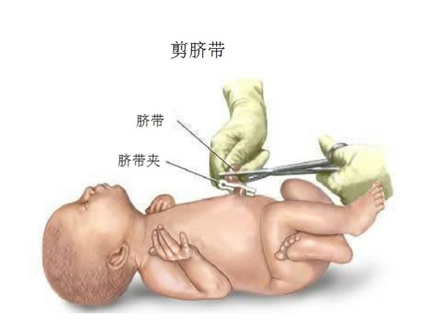 新生儿脐带夹打开图解图片