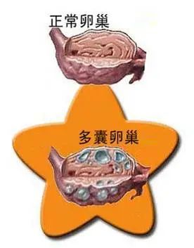 多囊卵巢一定就是多囊卵巢综合征吗