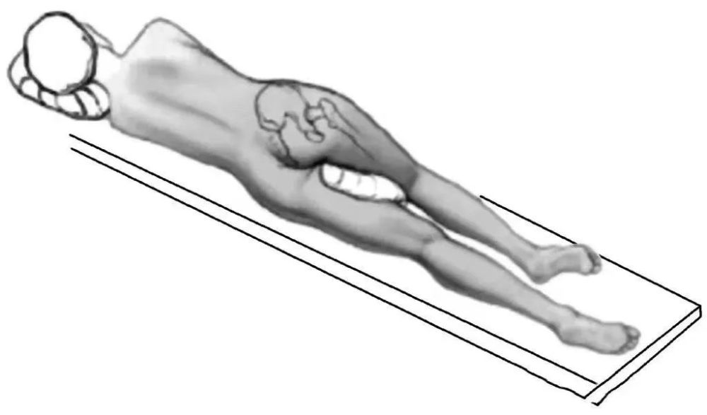 圖12 髖關節後側入路體位患者取健側臥位,骨盆前後於恥骨聯合及骶骨處