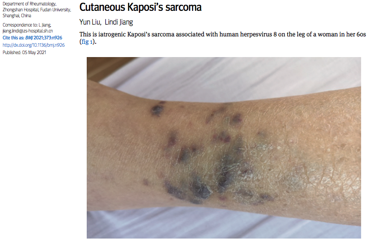 中山医院成功诊治一例特殊的卡波西肉瘤