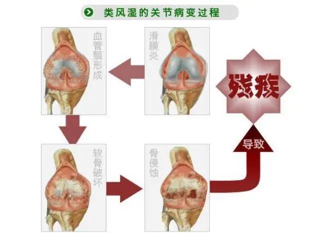 骨病的头号致残杀手