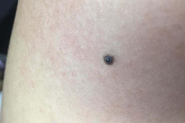 若长大,或许就麻烦了,别不当一回事|脂肪肝|蜘蛛痣|黑痣|恶性黑色素瘤