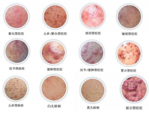 痘痘和粉刺是一回事吗应该如何预防