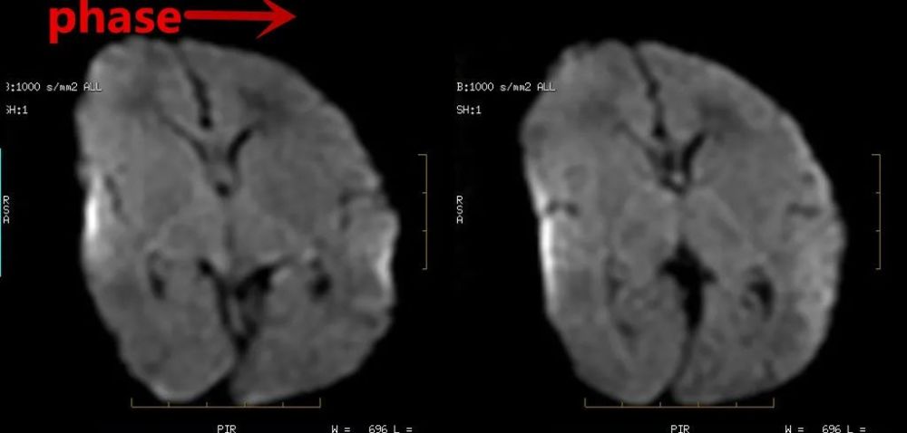 这个mri伪影 你了解了吗 Qtc Care