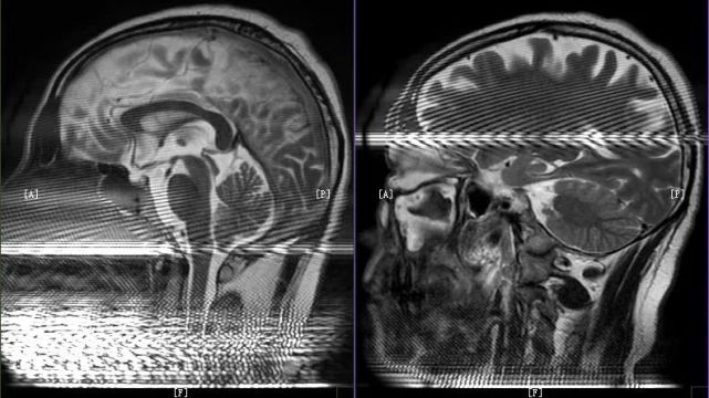 這20個mri偽影,你瞭解了嗎?