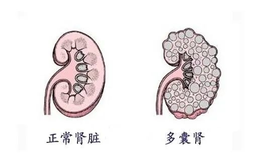 肾脏病不能跟着感觉走出现以下症状需要引起关注