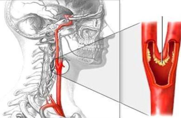 頸動脈發生堵塞哪個部位反應最強烈希望看完後對你有幫助