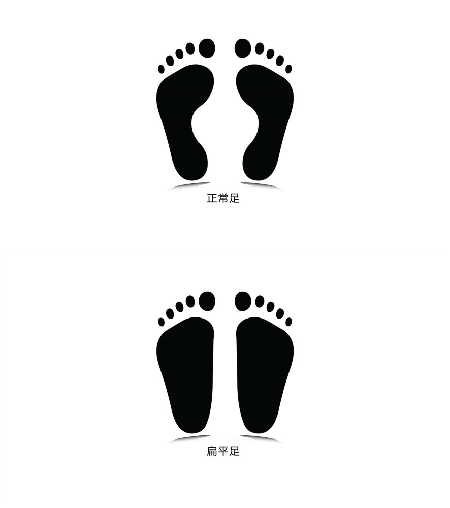 扁平足危害这么大,你却不以为然,一分钟自测是不是扁平足