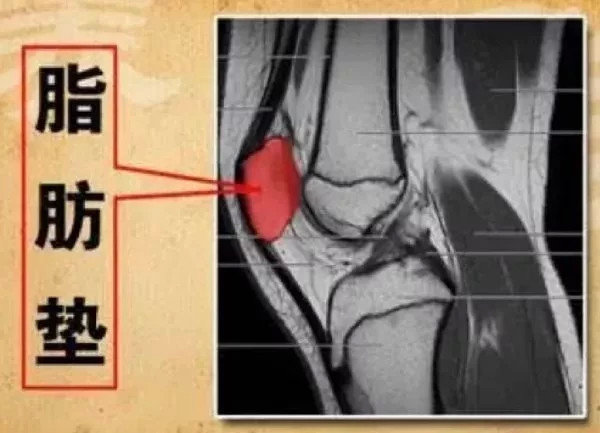 髌下脂肪垫损伤是怎么回事 髌下脂肪垫损伤应该如何治疗 腾讯新闻