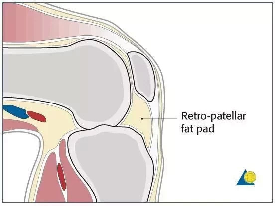 髌下脂肪垫损伤是怎么回事 髌下脂肪垫损伤应该如何治疗 腾讯新闻