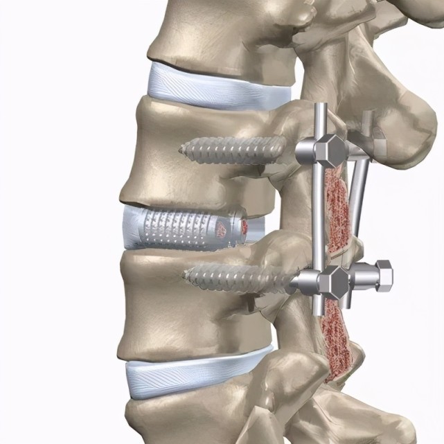 脊柱患者惧怕的打钉子手术,到底要不要做?