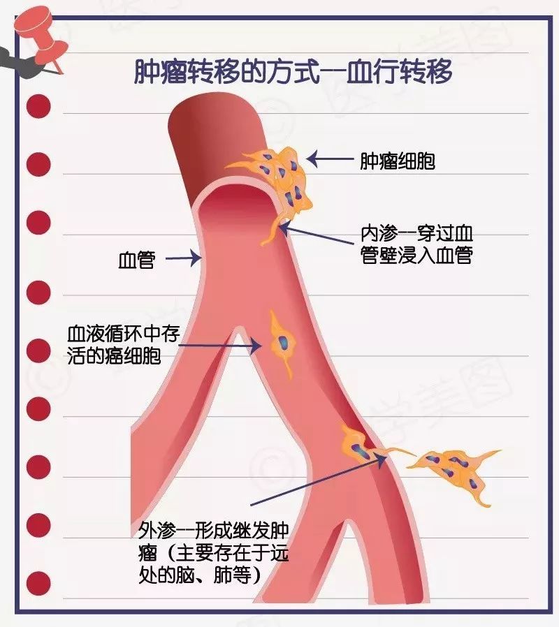 癌症转移,癌细胞最容易转移至哪些部位?