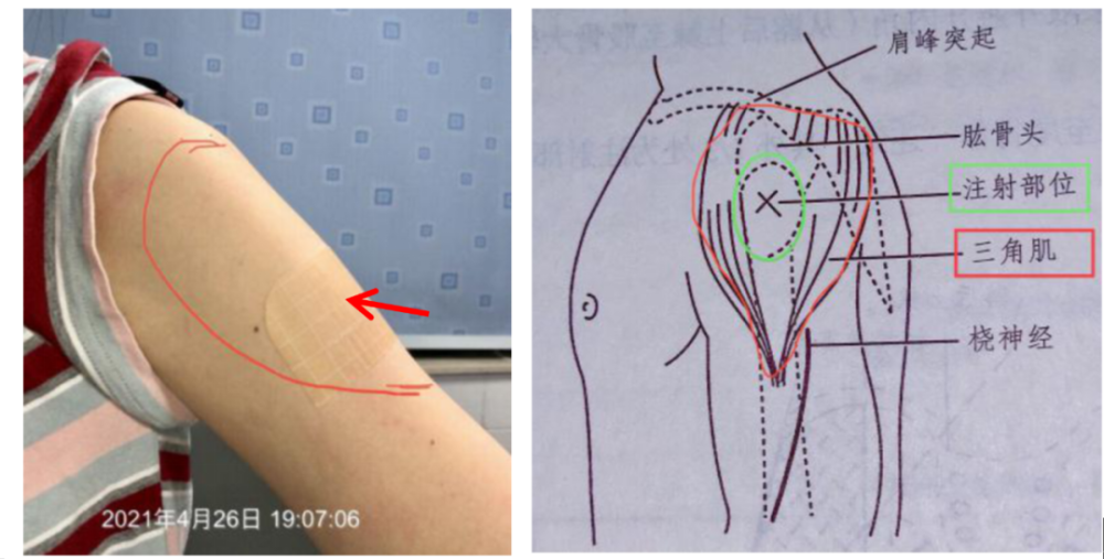 我仔細看了她的注射部位,發現注射部位有少許淡淡的瘀斑,且三角肌肌注