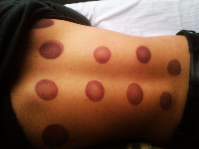 拔罐刮痧的作用及注意事项