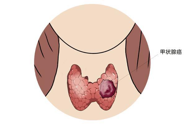 体内有癌,咽喉或先知!若出现声音沙哑,喉咙痛,或是癌症信号