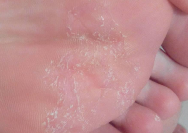 血糖较高的人脚部或会有这3个表现一起来看一下吧