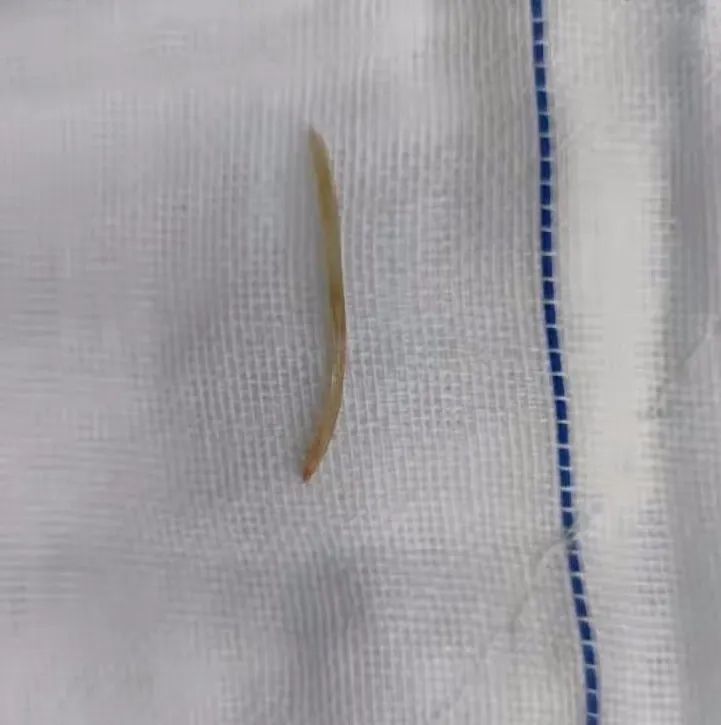 可怕惠阳一女子误吞鱼刺刺穿消化道小心这个习惯动作