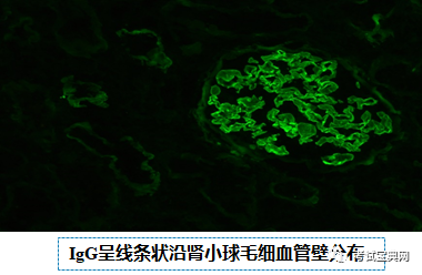 Ⅰ型和Ⅲ型無電子緻密物l 光鏡:ii型常伴有腎小球毛細血管內皮細胞和