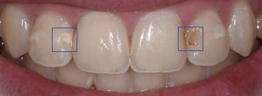 如果你有龋齿(也就是虫牙),当龋齿的深度突破了牙釉质,到达了牙本质