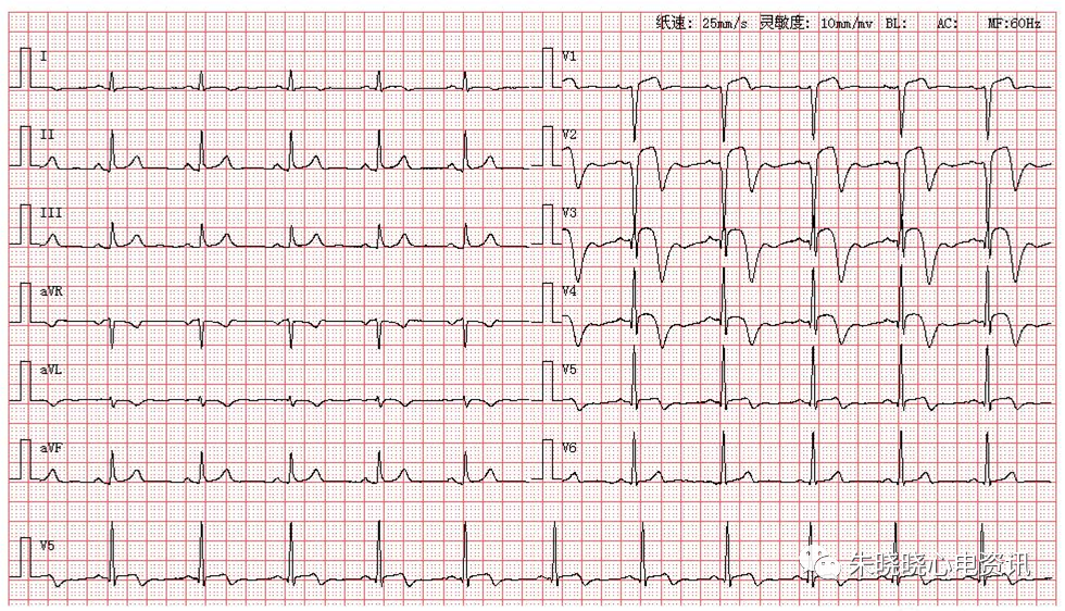 患者男,65岁,突发剧烈胸痛三小时来医院就诊,图为其体检心电图第1369