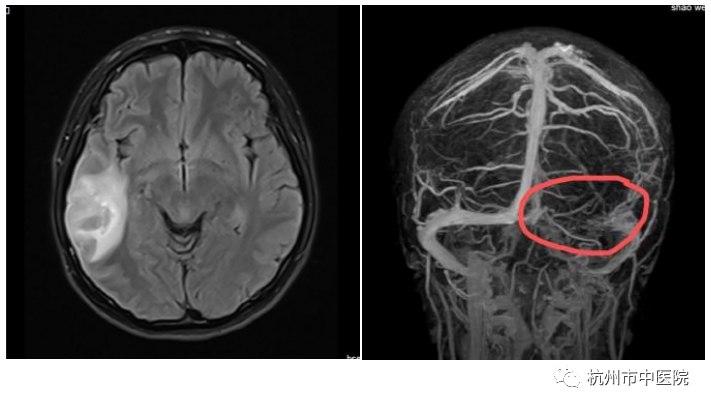 长期吃避孕药,26岁姑娘竟患上脑血栓!这种头痛千万要警惕!