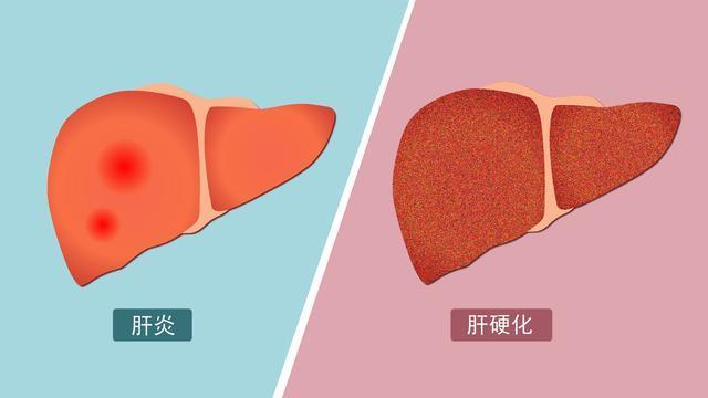 肝硬化患者不能吃魚醫生提醒肝若不好避開這4種魚